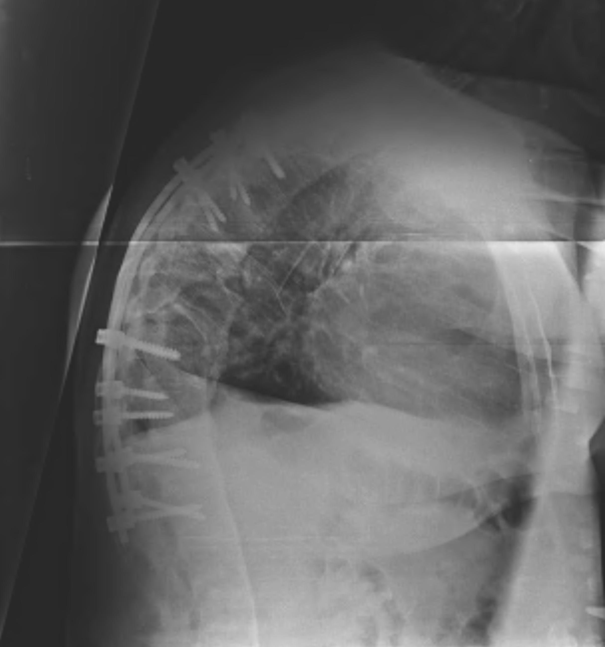 Ankylosing Spondylitis Thoracic Fracture Stabilisation Lateral